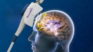 NeuroStar device targeting brain regions, illustrating what conditions can TMS treat through focused magnetic stimulation.